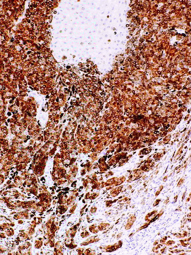 [GenomeMe] MART-1 (Melan A)