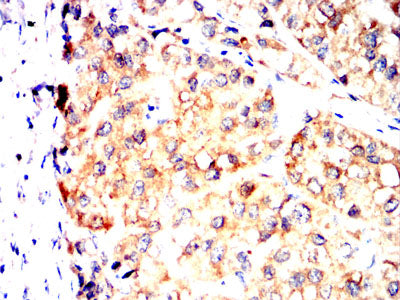 설명: Figure 6:Immunohistochemical analysis of paraffin-embedded liver cancer tissues using SV2C mouse mAb with DAB staining.
